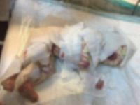 Milyonda Bir Görülen Bir Hastalıkla Dünyaya Geldi