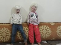 Albino Kardeşler Yardım Bekliyor