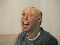 Vücudu Yanan Mehmet Ali’nin Dramı