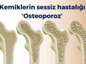 Kemiklerin Sessiz Hastalığı ‘Osteoporoz’