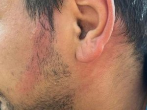 Ümraniye’de İ̇ett Otobüsünün Klima Borusu Patladı, Bir Yolcunun Yüzü Yandı