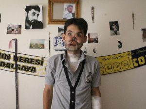 Yüzünde Tüfek Fişeği Patlayan Ahmet İlk Ameliyatını Oldu