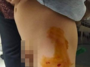 Mardin’de Sokak Köpeği 6 Yaşındaki Çocuğu Isırdı