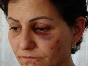 Arabayla Takip Ettikleri Anne Ve Kızı Döverek Hastanelik Ettiler