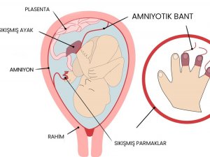 Amniyotik Bant Sendromu Olan Bebekler Anne Karnında Ameliyat İle Tedavi Edilebiliyor