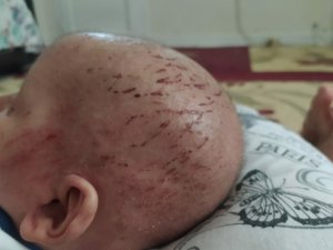 ’Balık Pulu’ Hastalığıyla Yaşayan Çocuğun Hayatı Kabusa Döndü