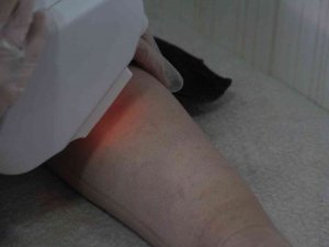 Lazer Kadının Vücudunu Yakmıştı, Başka Bir Güzellik Uzmanı Tedavisini Üstlendi