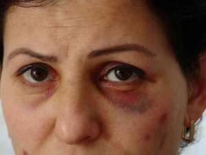 Arabayla Takip Edilip Sokak Ortasında Darbedilen Anne Ve Kızı İçin Koruma Kararı Çıktı