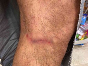 Çankaya’da Başıboş Köpekler Vatandaşın Kıyafetlerini Parçaladı