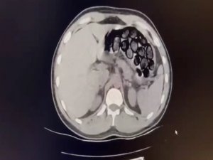 Mide Ve Bağırsağından 65 Kapsül Uyuşturucu Çıktı