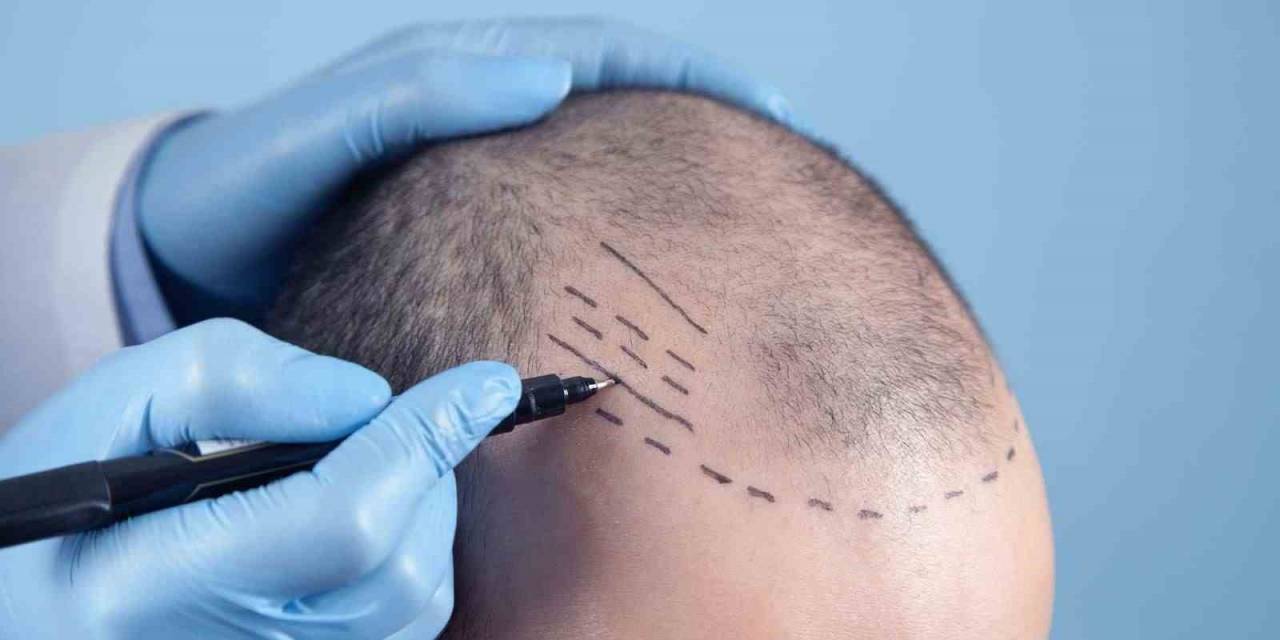 Dünyanın En İyi Saç Ekim Merkezleri Türkiye’de