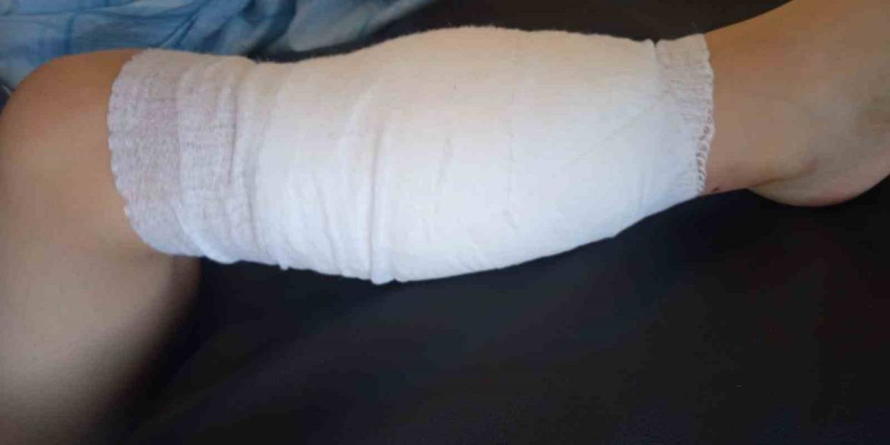 Pitpull Cinsi Köpeğin Saldırdığı 5 Yaşındaki Çocuk Hastanelik Oldu