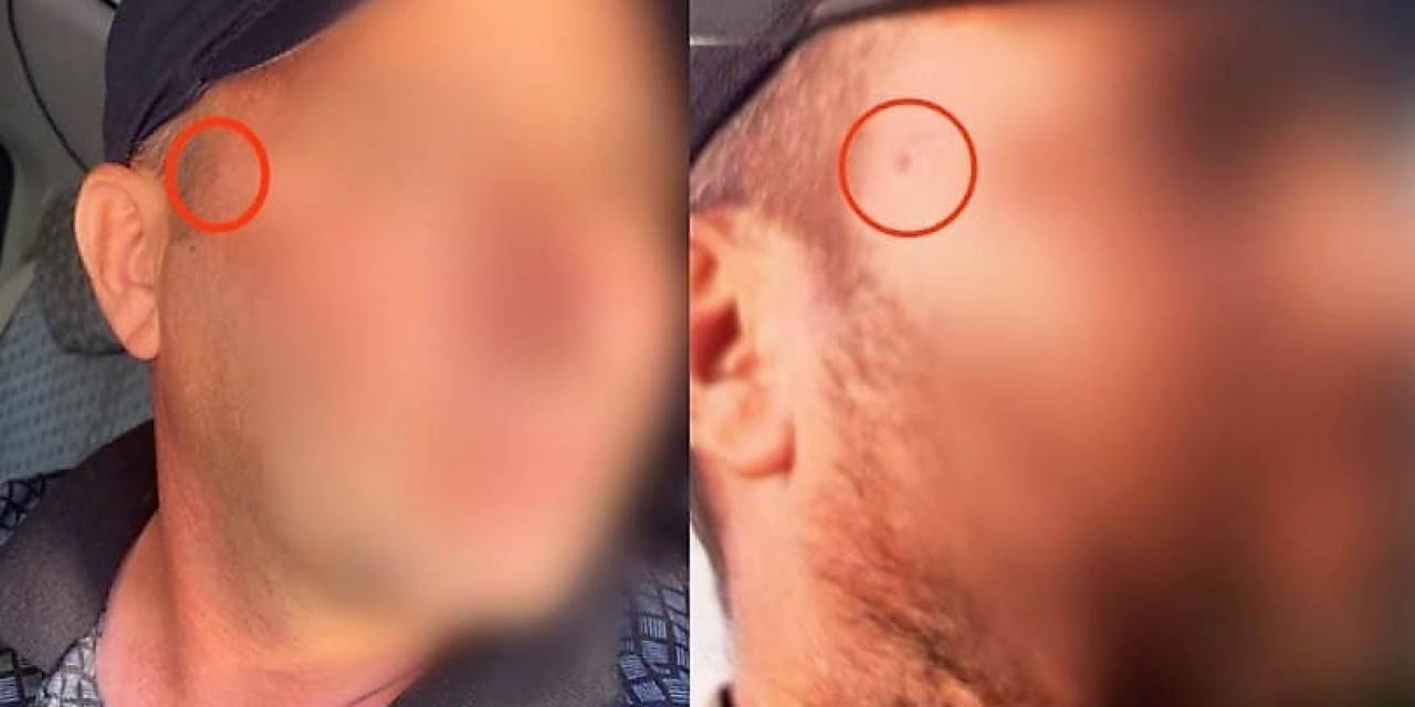 Jandarma Korkusundan Yüzündeki Beni Aldırdı