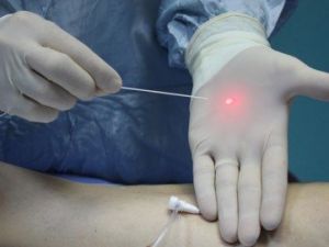 Lazer Teknolojisiyle Varis Tedavisi