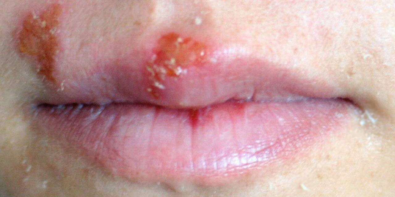 Uçuk Deyip Geçmeyin