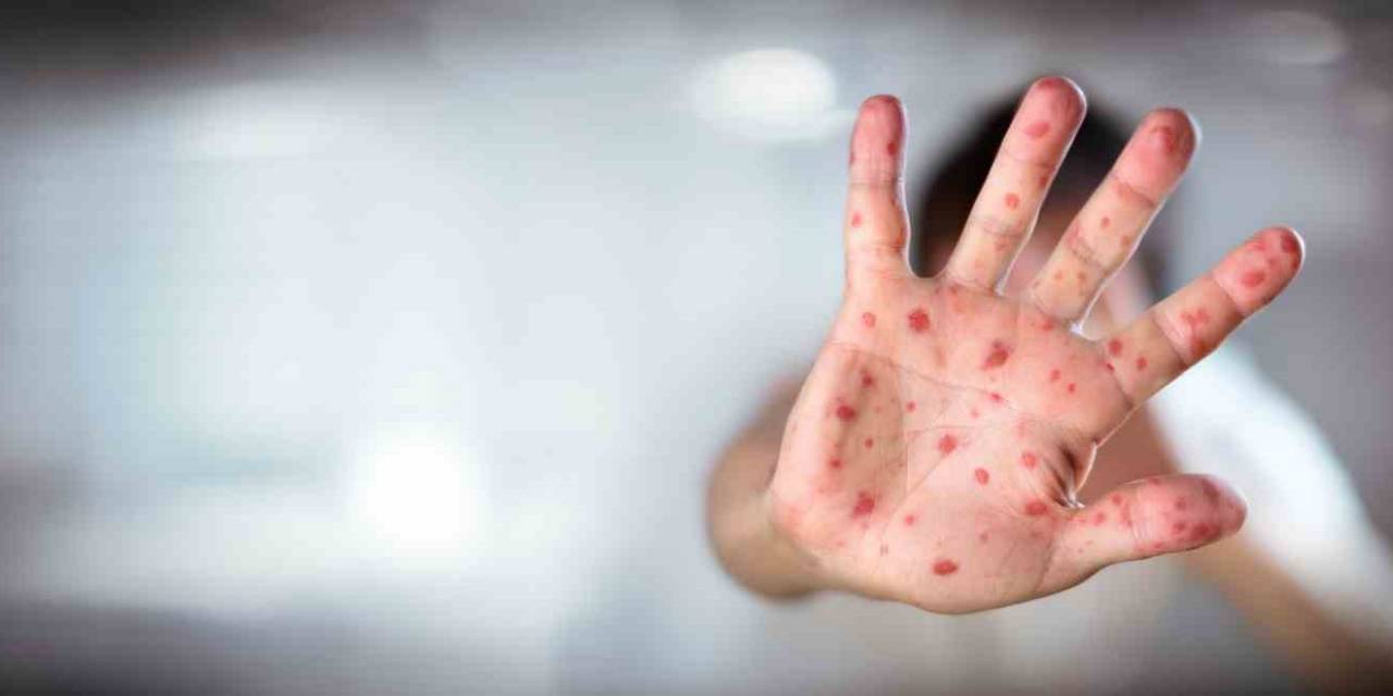 “kızamık Vakalarındaki Artışın En Önemli Sebebi Aşı Karşıtlığı”