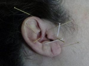 Erkek Kısırlığında Yeni Tedavi Yöntemi: Akupunktur