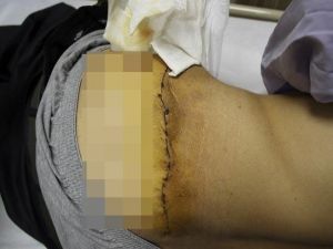 Tümör Nedeniyle 6 Yıl Boyunca Uyuyamadı