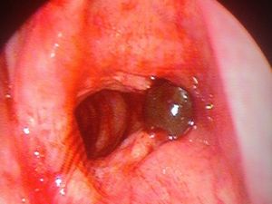 Ses Tellerine Sülük Yapışan Şahıs Ameliyat Edildi