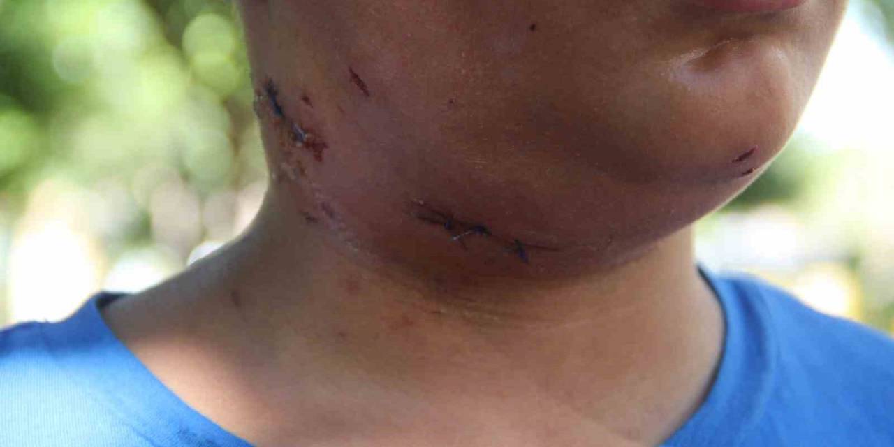 Köpek Saldırısına Uğrayan 10 Yaşındaki Çocuk Ölümden Döndü