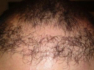 Merdiven Altı Saç Ekim Merkezi Mağduru Şikayetçi Oldu