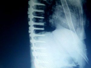 Edremit’te Bir Hastaya Erimeyen Platinden Omurga Yapıldı