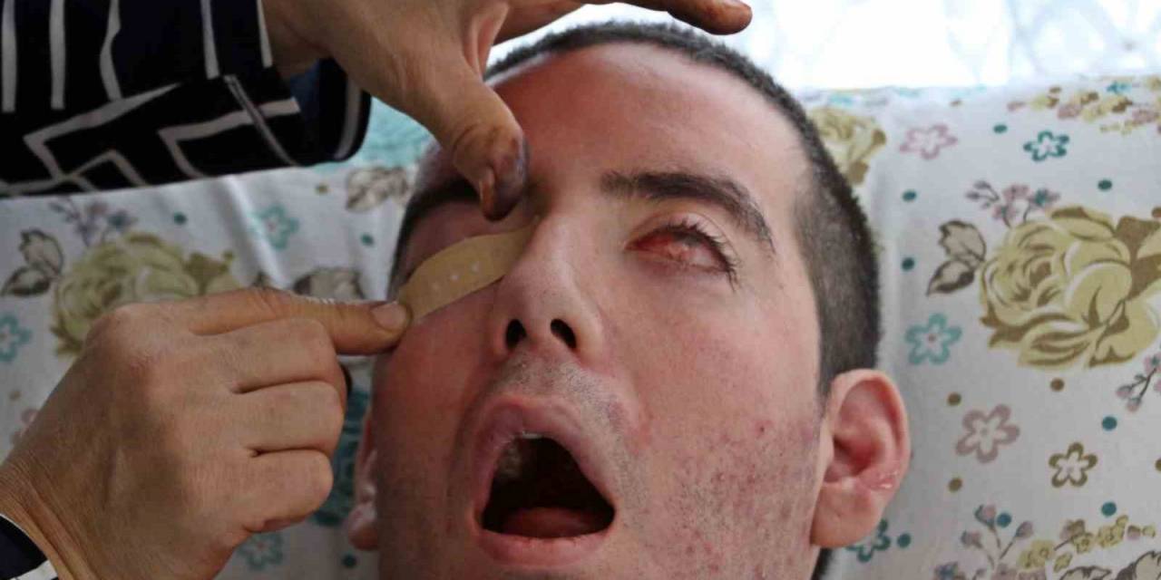 Görme Bozukluğuyla Başladı, 10 Yıldır Gözlerini Kapatamıyor