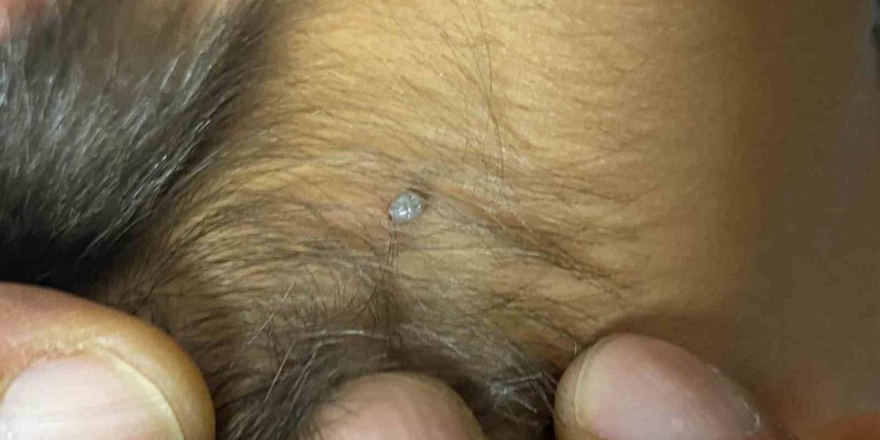 Konya’da 4 Yaşındaki Çocuğa Kene Yapıştı