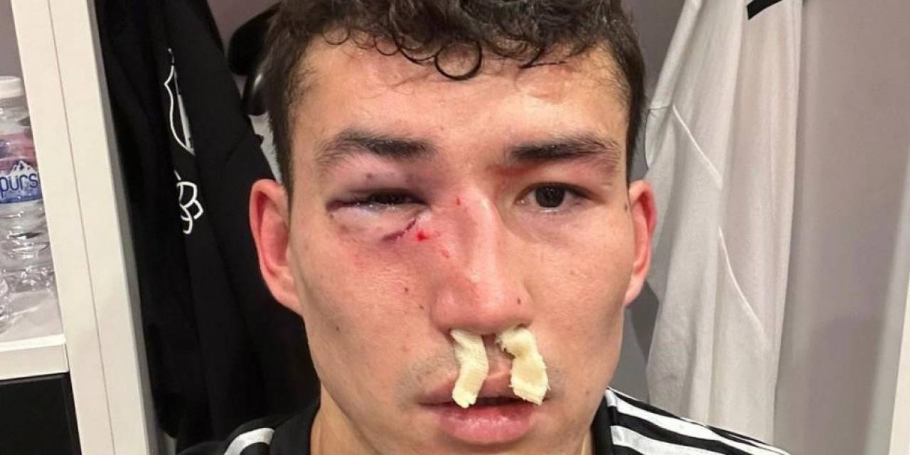 Beşiktaş: "Zaynutdinov’un Burnunda Ve Göz Çukurunda Kırık Saptanmıştır"