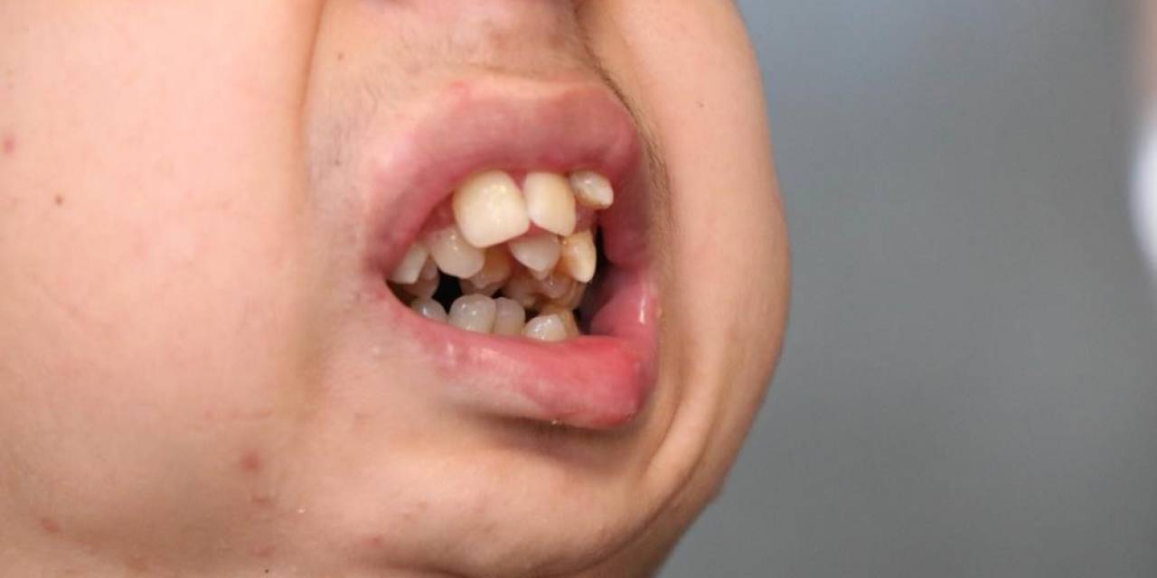 Alt Çenesi Yok, Dişleri Üst Damağında: Ameliyat İçin Yardım Bekliyor