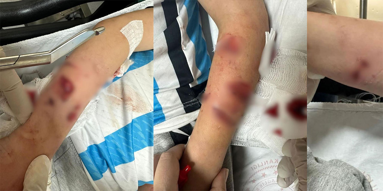 Rize'de sahipsiz köpeklerin saldırısına uğrayan çocuk yaralandı