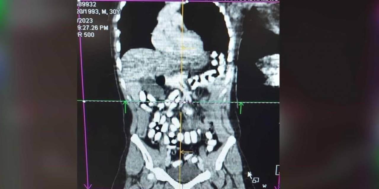 Midesinde Uyuşturucu Taşıyan Şahıs Tutuklandı