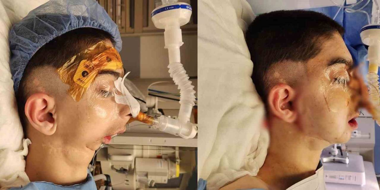 Doğuştan Alt Çenesi Olmayan Çocuğa Başarılı Operasyon: 17 Yıl Sonra Normal Yemek Yiyebilecek