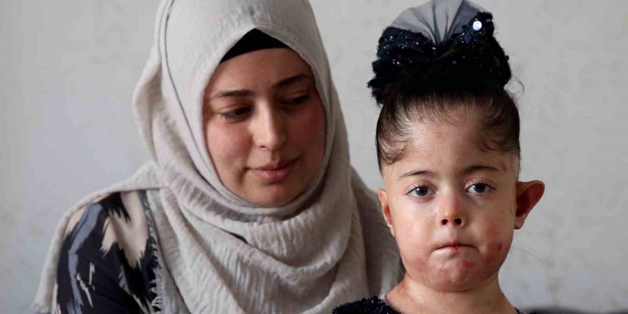 Tek Dileği Kelebek Hastası Kızına Doyasıya Sarılabilmek