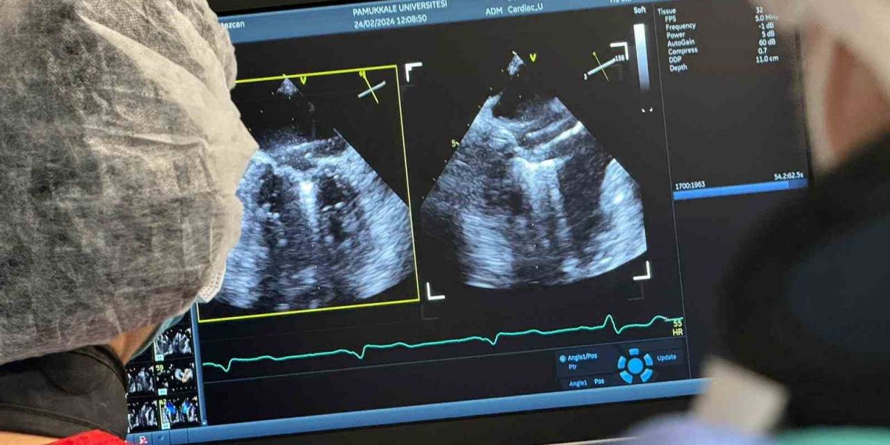 Denizli’de İlk Defa Ameliyatsız Mitral Kapak Yetmezliği Tamiri Yapıldı