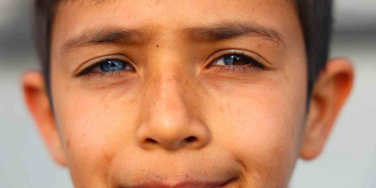 Hayata Çift Renk Bakıyor, Görenler Hayrete Düşüyor