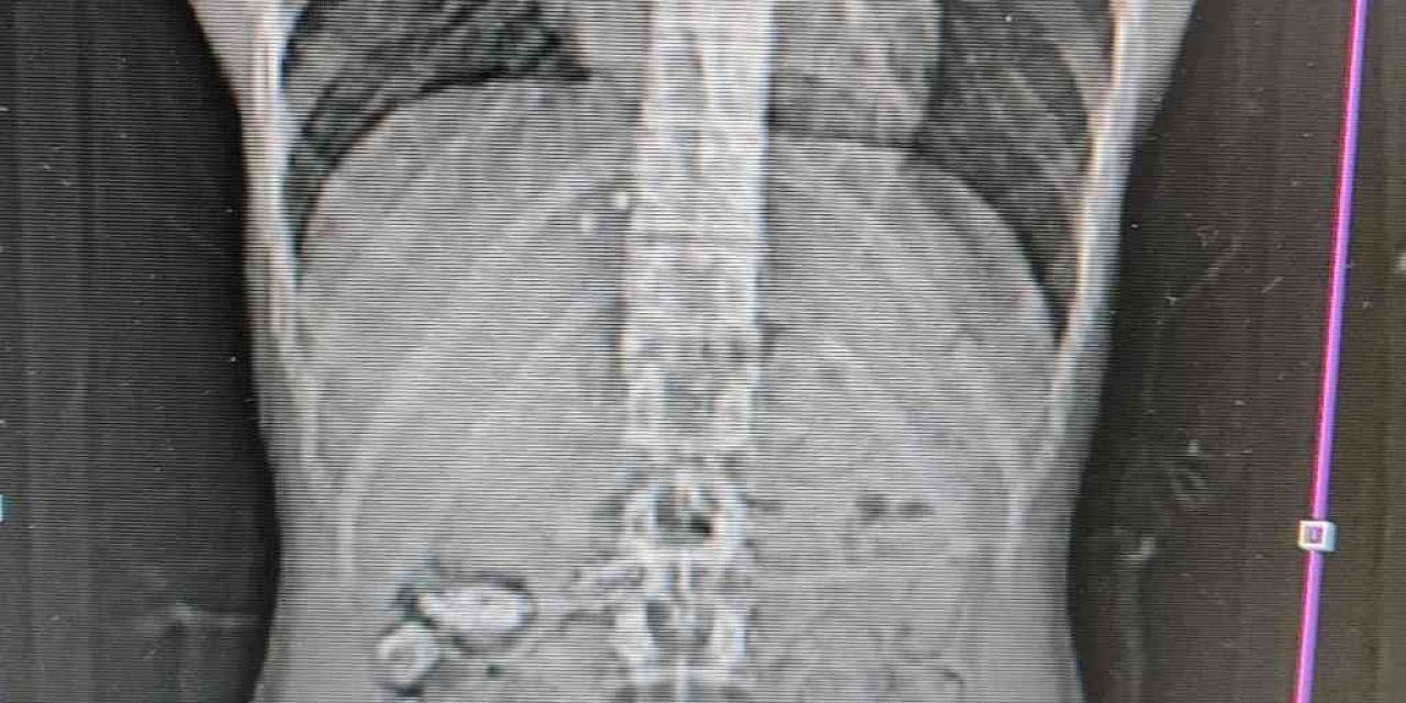 Uyuşturucu Kuryesinin Midesinden 18 Kapsül Çıktı