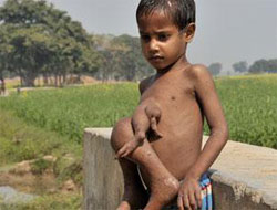 Göğsünde kardeşinin bacakları var