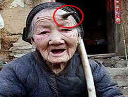 101 Yaşındaki Kadının Boynuzu Çıktı!