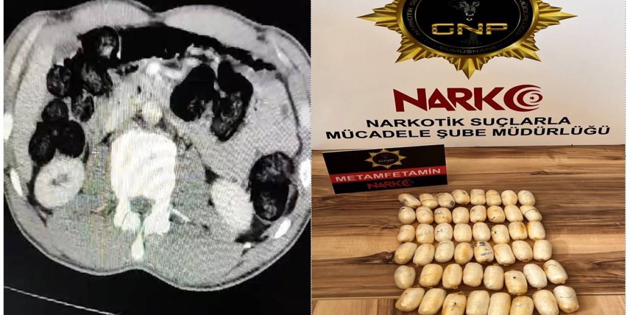 Yabancı Uyruklu Şahsın Midesinden 53 Paket Uyuşturucu Çıktı
