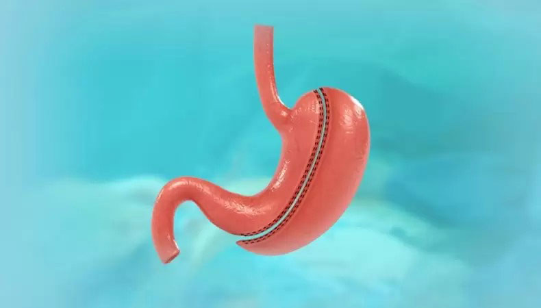 Tüp mide ameliyatı Nedir ?