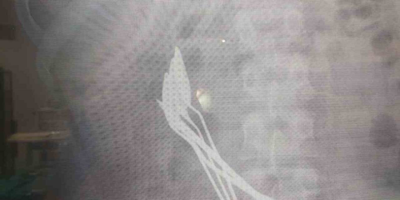 Çocuğun Midesinden Çıkanlar Şaşırttı