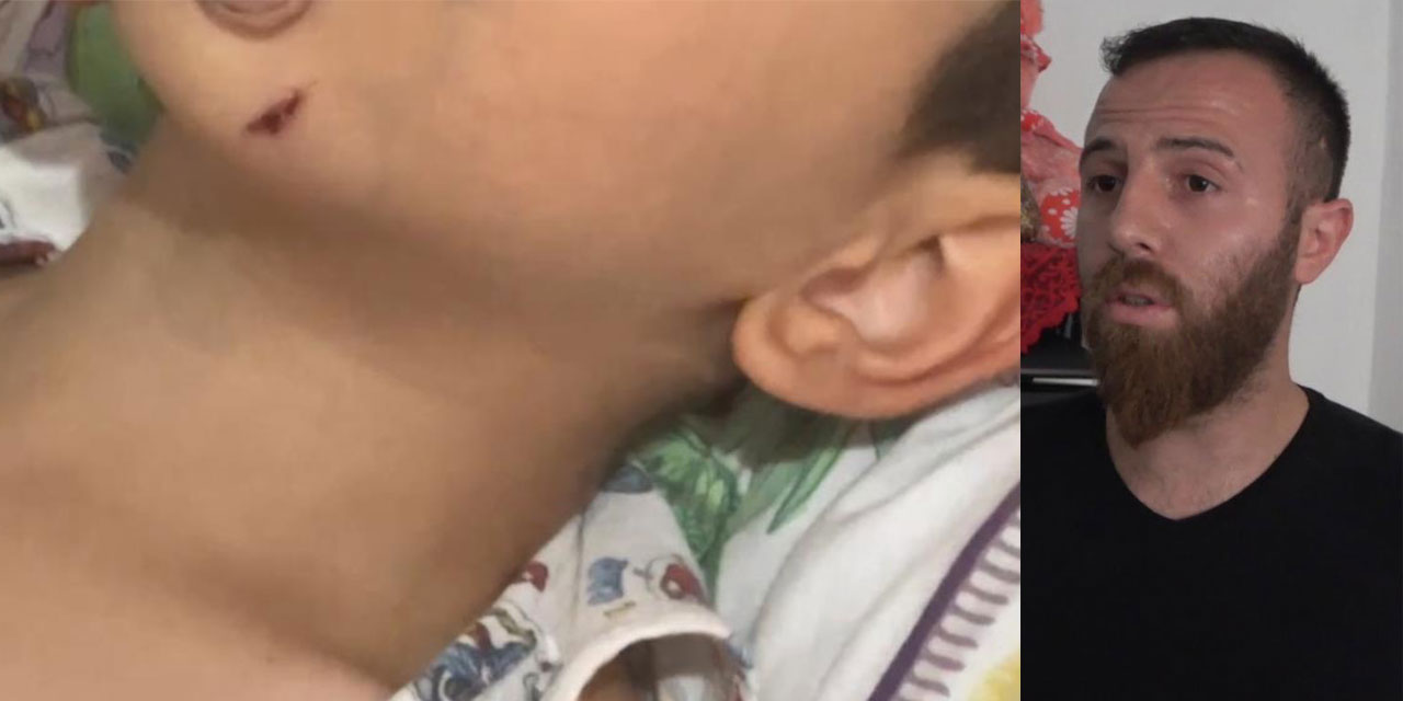 Rize’de 5 yaşındaki çocuk, sokak köpeğinin saldırısına uğradı