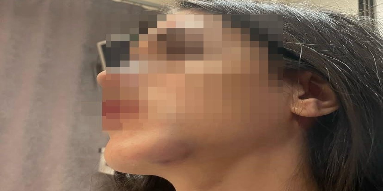 Eski sevgilisi tarafından darbedildiğini iddia edip, fotoğraflarını sosyal medyada paylaştı