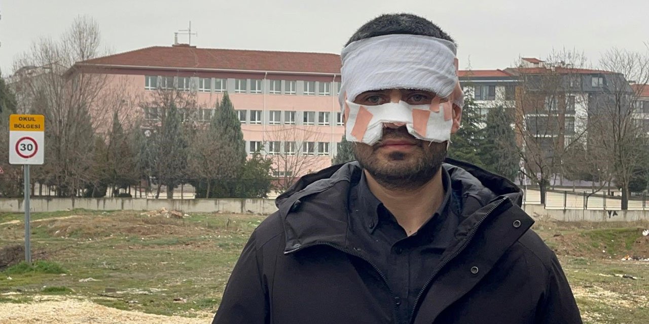 Rehber öğretmenin yüzüne sıcak çay fırlattığı fizik öğretmeni feci şekilde yandı