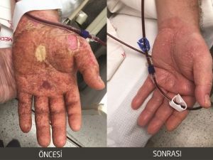 Romatizmal Hasta ‘Aferez Tekniği’ Sayesinde Sağlığına Kavuştu