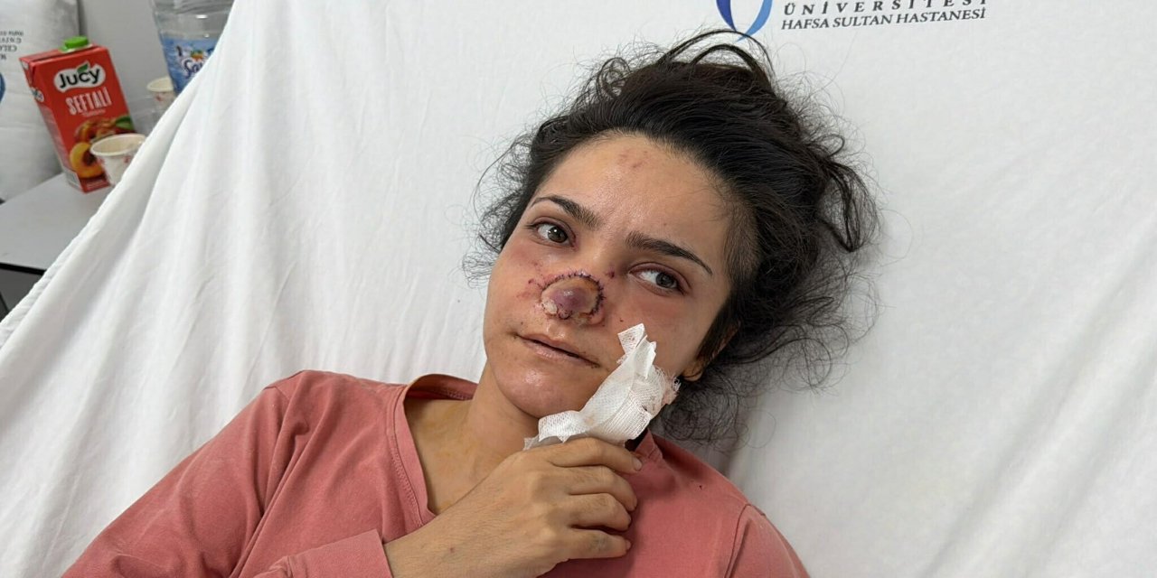 Eşi tarafından burnu ısırılıp koparılan İmran: Canımın acısıyla balkondan atlamayı bile düşündüm