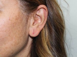 Küçük Yaştaki Kız Çocuklarına Takılan Küpe, Kulak Memesini Yırtabilir