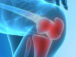 Protez Operasyonu Sonrası Fizik Tedavinin Önemi