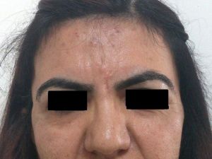 Yağ Dolgusu İle Alın Bölgesindeki Çöküklük Düzeltildi